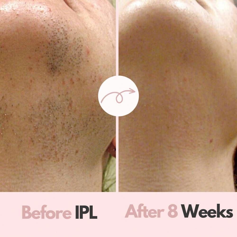 IPL Hair Removal Device – 9 Levels of Irradiation & 2 Modes