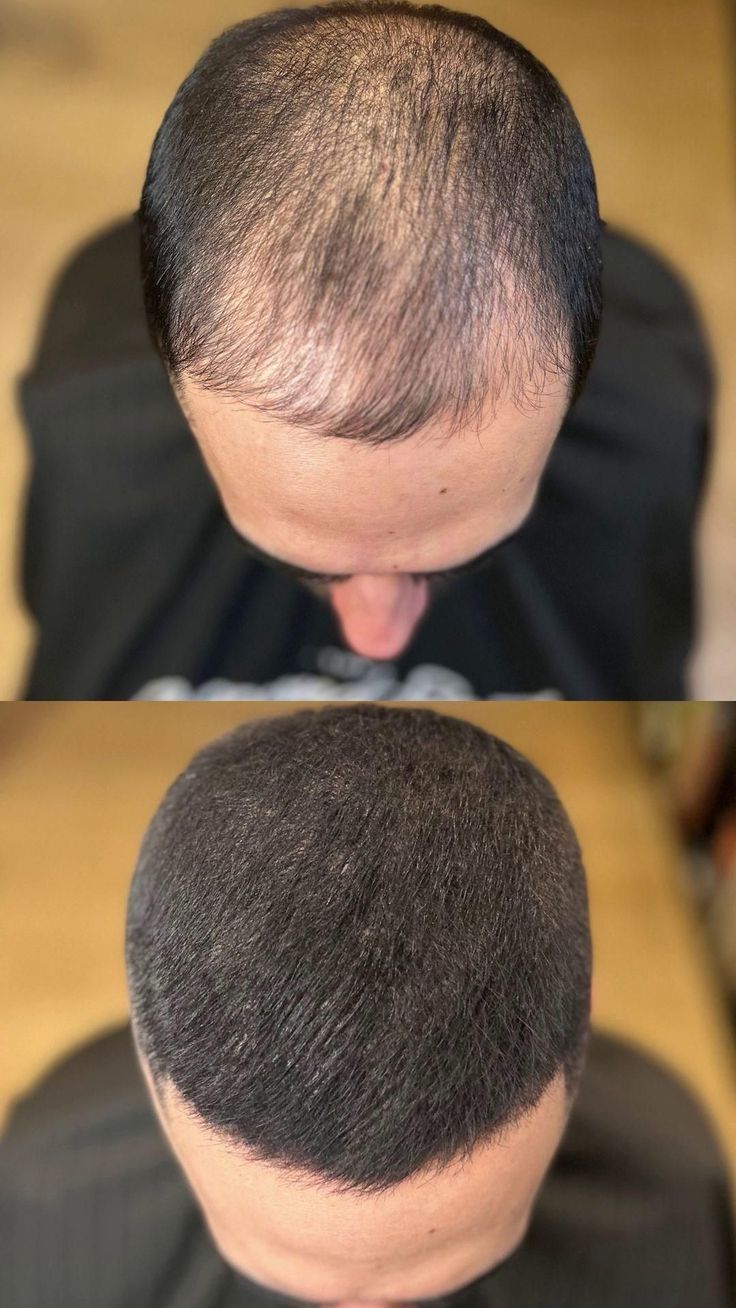 DERMA ROLLER FOR HAIR