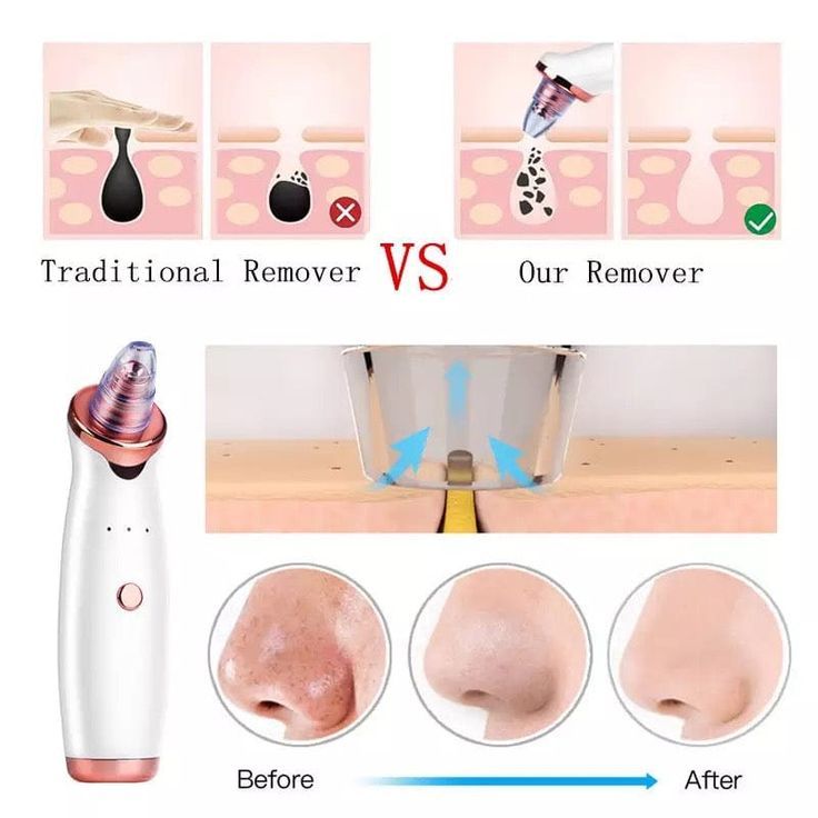 BLACK AND WHITE HEADS SUCTION MACHINE