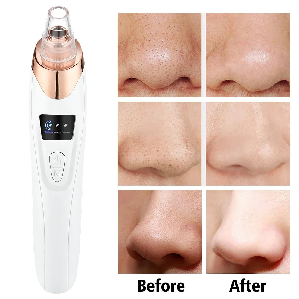 BLACK HEADS ACNE OIL REMOVER 5 in 1