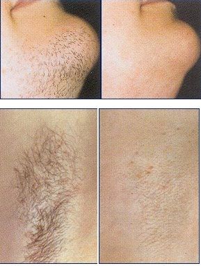 IPL LAZER-HAIR REMOVER REMOVER THE PERMENENT HAIR